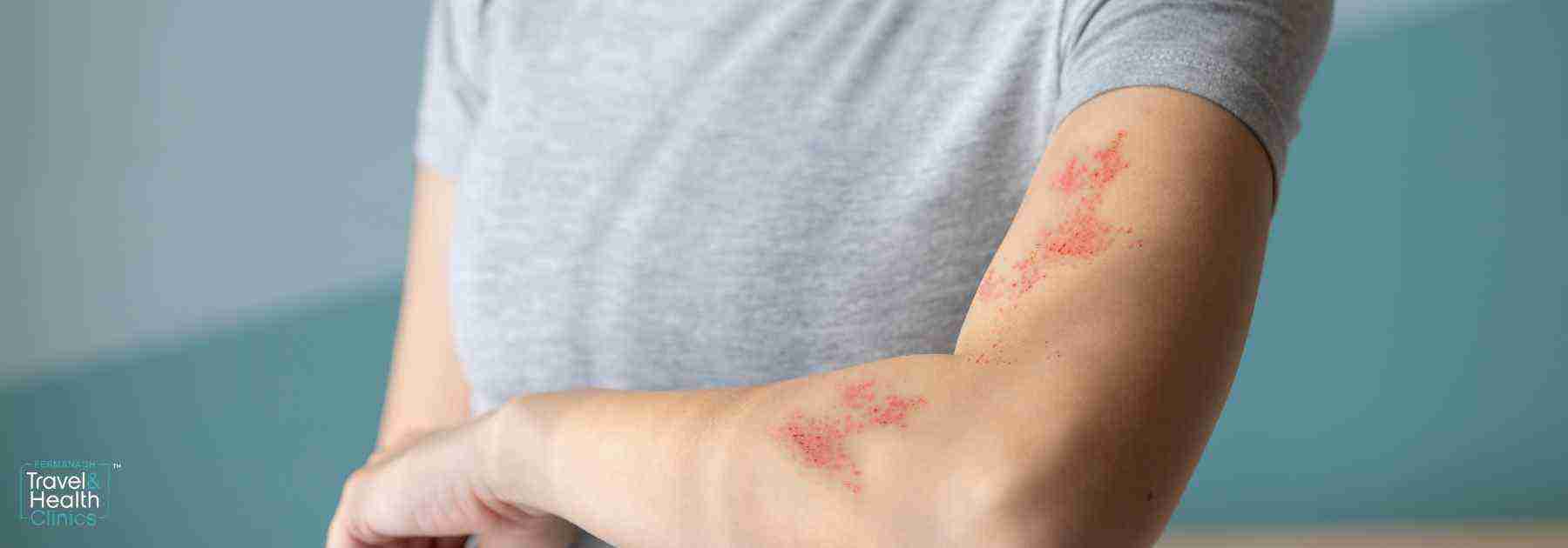 shingles vaccine near me