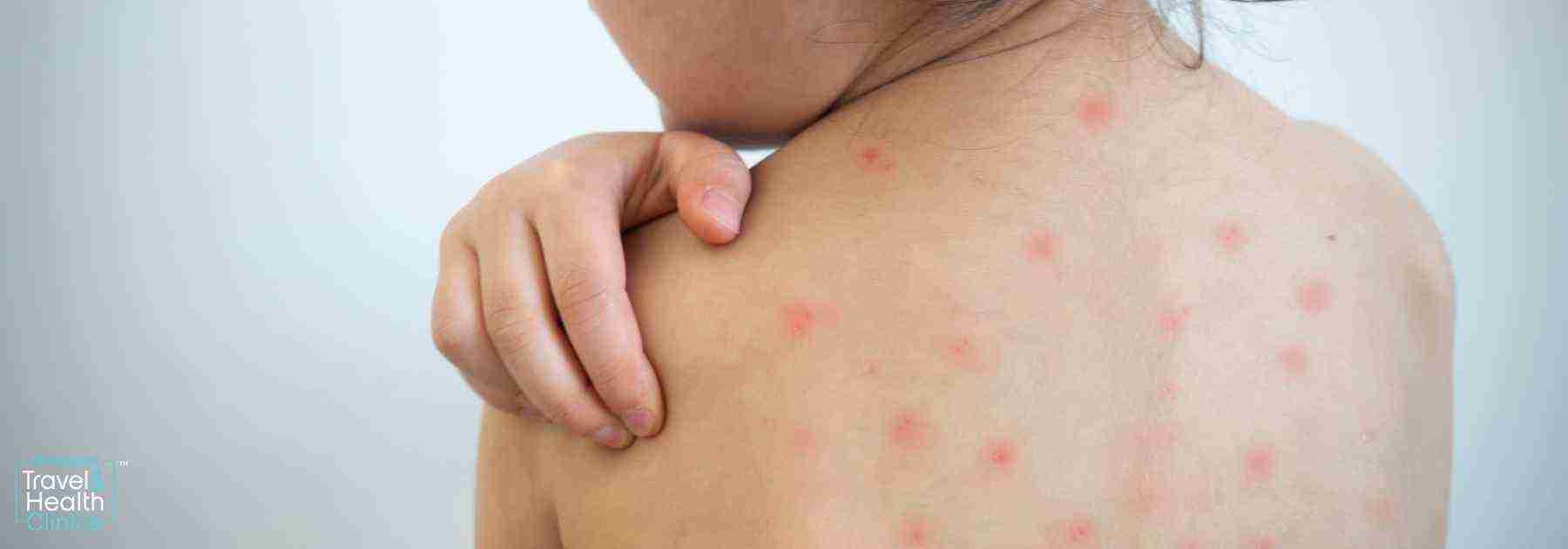 chickenpox vaccine fermanagh