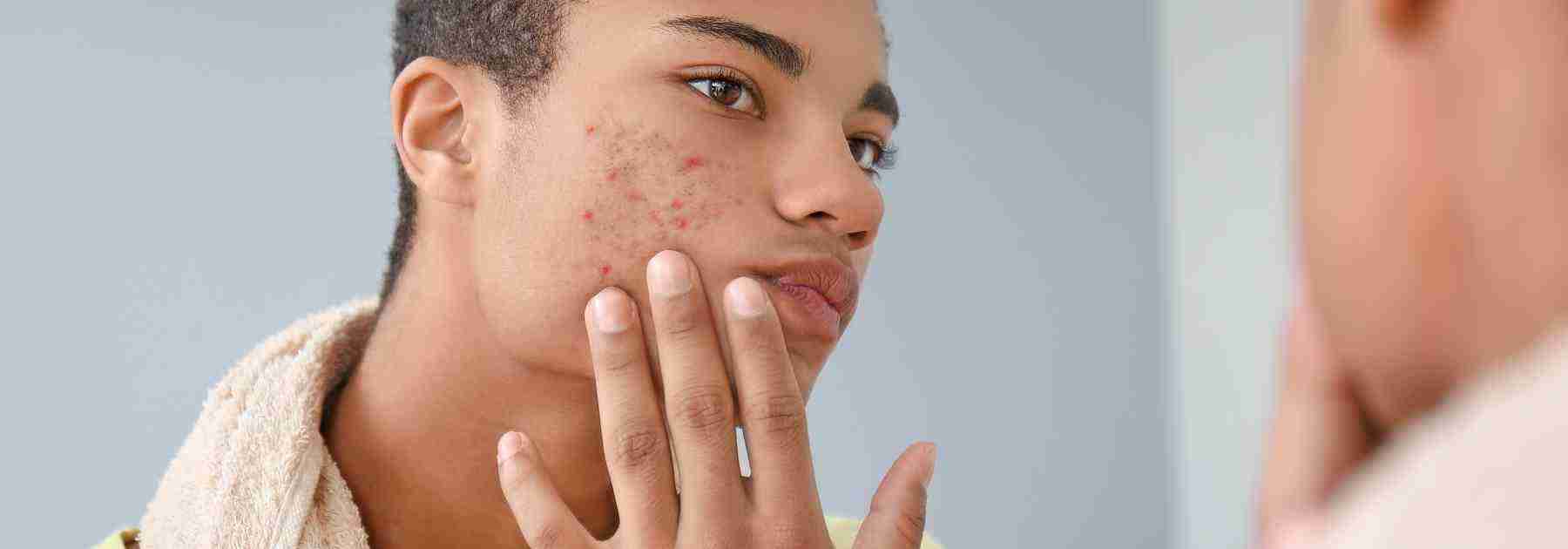 Find the best acne treatment for you
