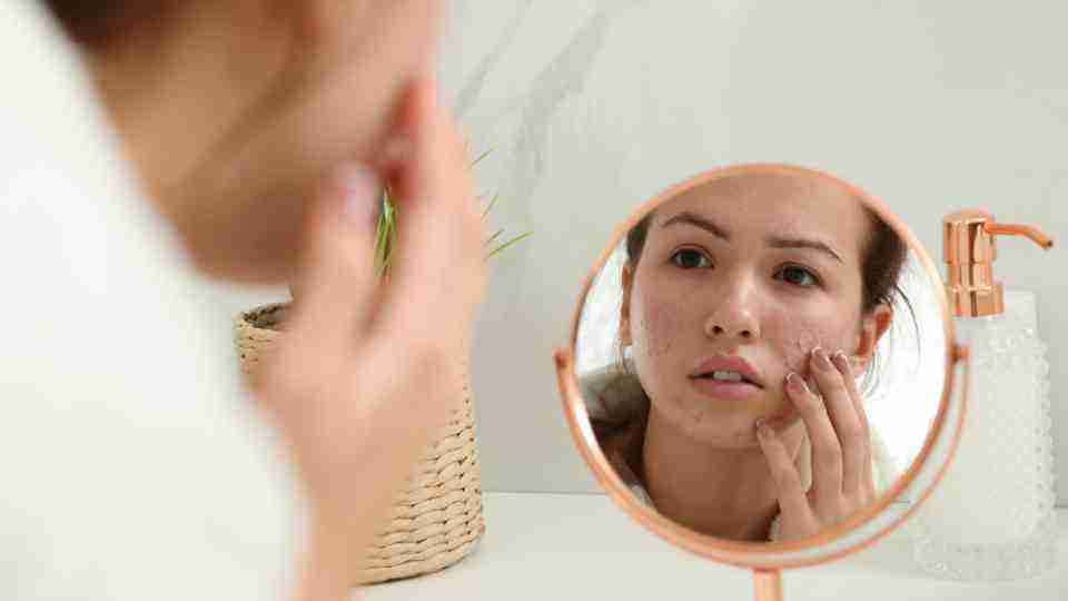 Compare teen and adult acne treatments