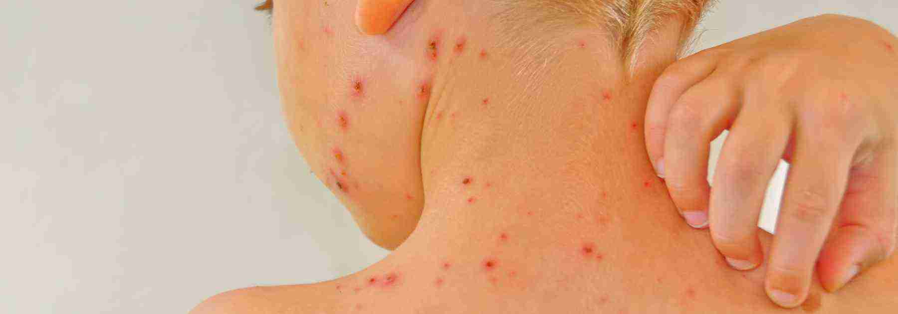 Chickenpox NHS vs private vaccination